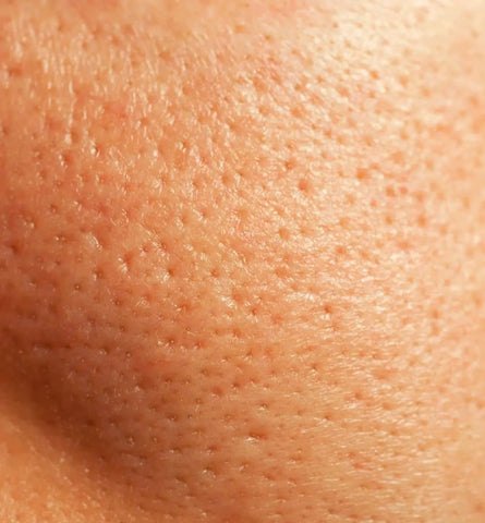 Blog Feed Article Feature Image Carousel: 5 Treatments for Uneven Skin Texture That We Swear By 
